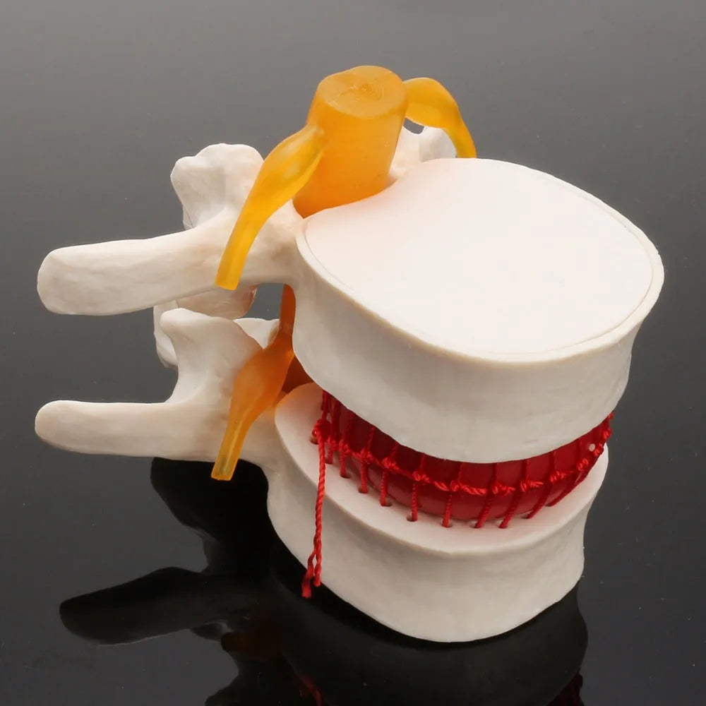 White PVC medical model of lumbar spine showing intervertebral disc herniation
