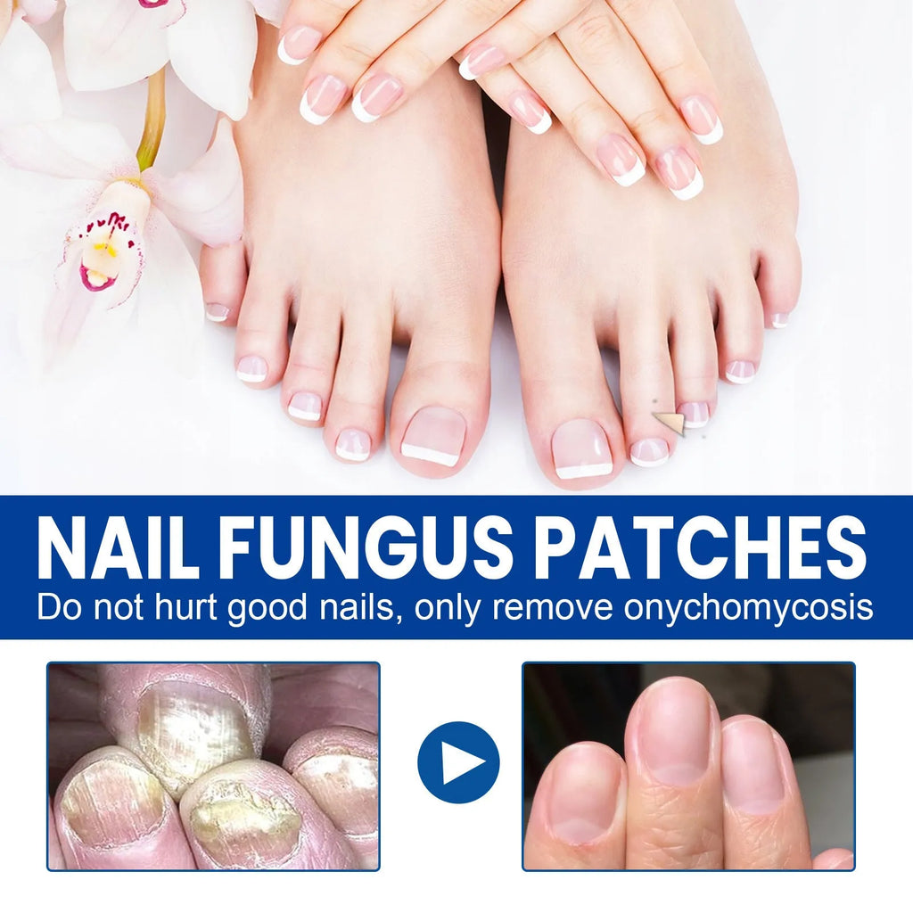 Box of 32 nail nursing adhesive bandage repair patches for weak or broken nails.