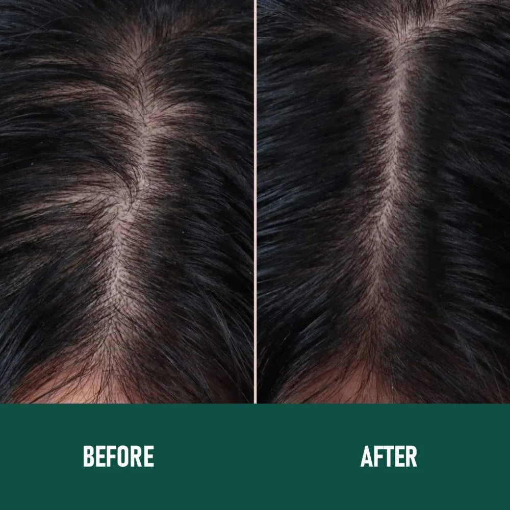 CH004 Minoxidil Anti-Hair Loss Mousse set box with three foam pieces for topical scalp treatment