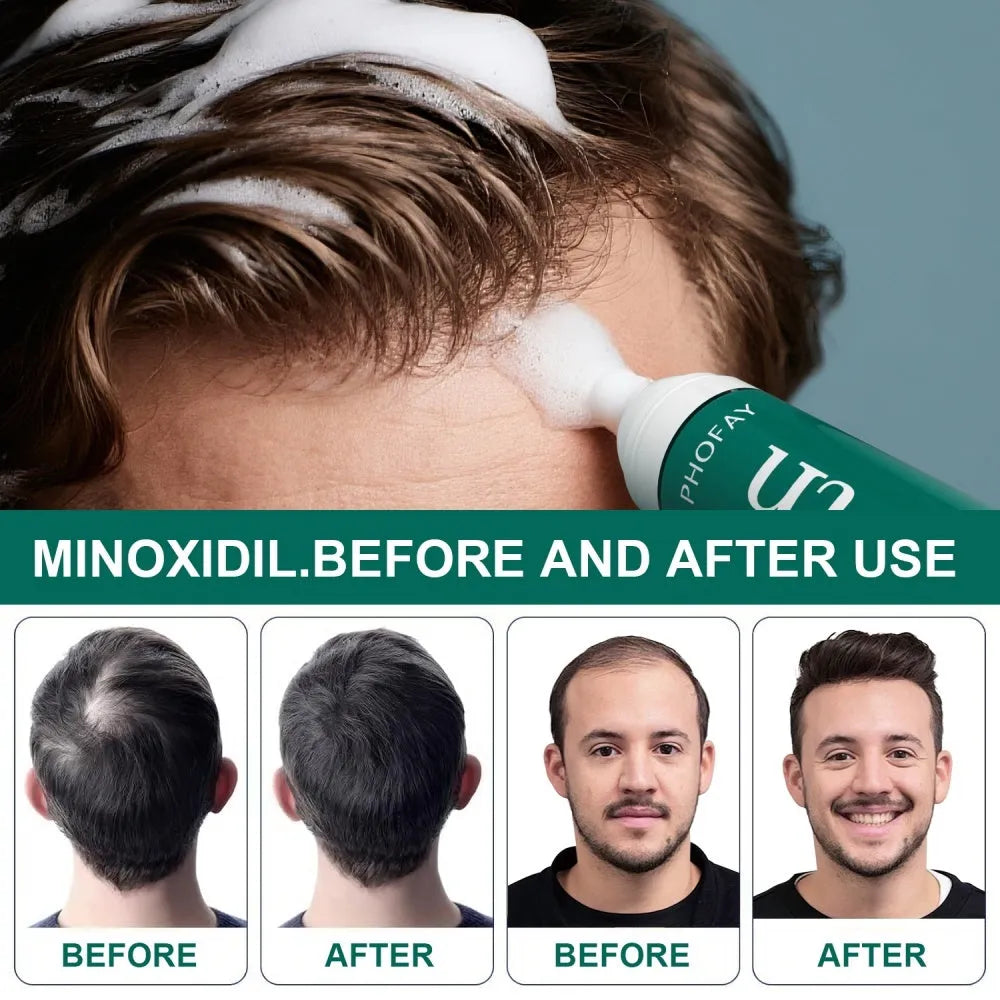 CH004 Minoxidil Anti-Hair Loss Mousse set box with three foam pieces for topical scalp treatment