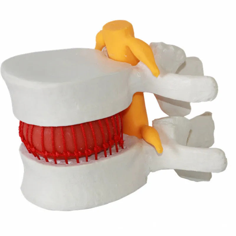 White PVC medical model of lumbar spine showing intervertebral disc herniation