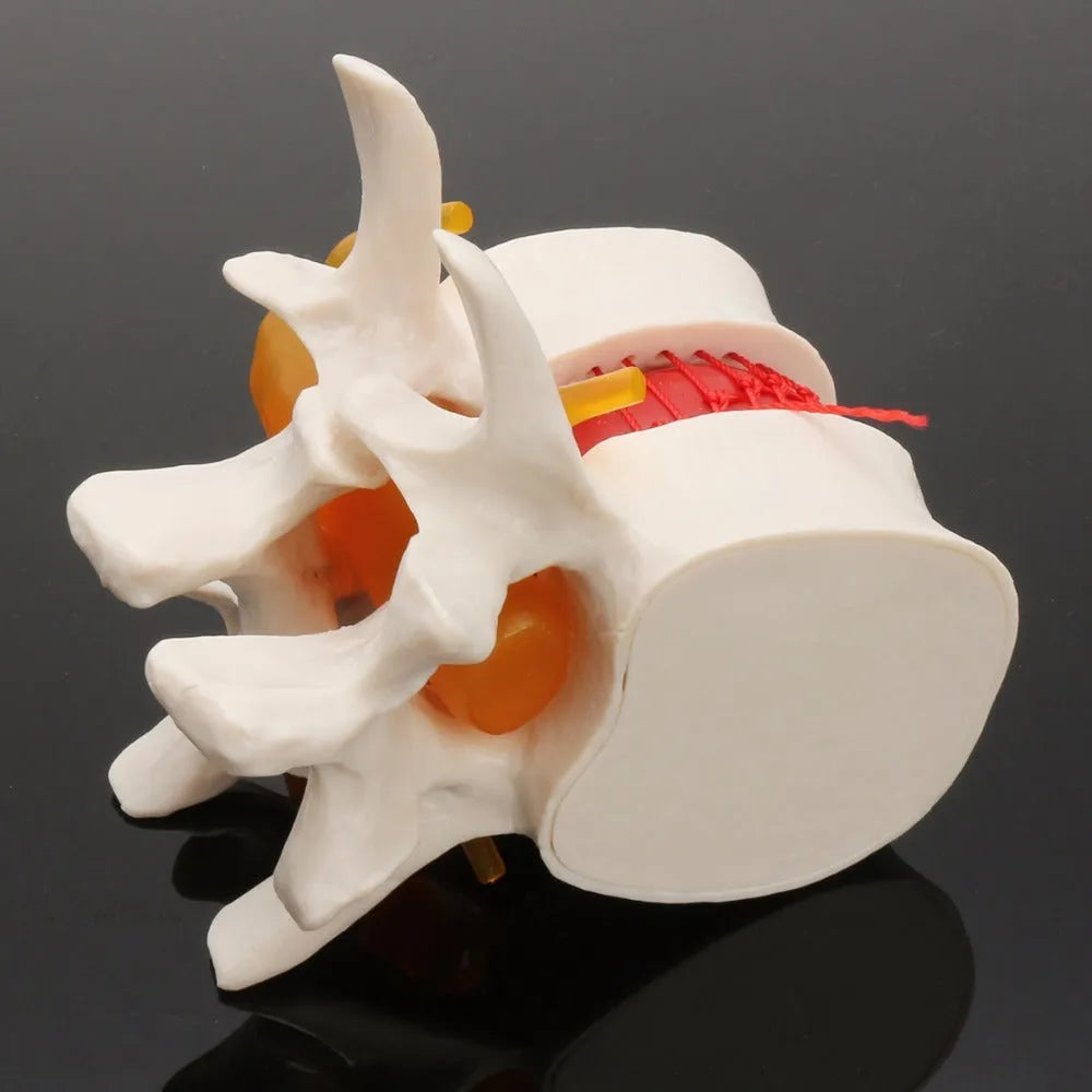 White PVC medical model of lumbar spine showing intervertebral disc herniation