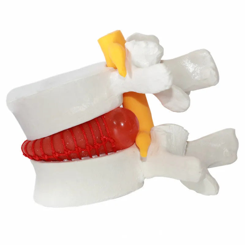 White PVC medical model of lumbar spine showing intervertebral disc herniation