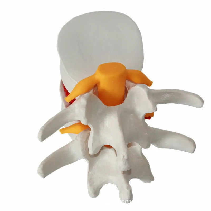 White PVC medical model of lumbar spine showing intervertebral disc herniation