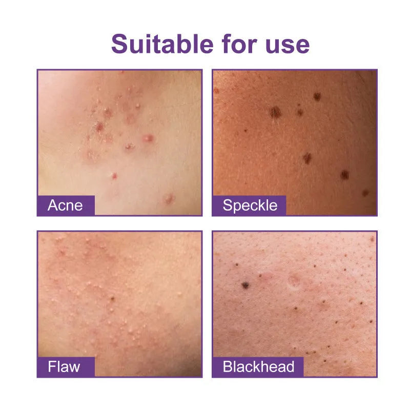 Anti-acne waterproof breathable acne patch pack of 180 pieces in compact 6.5x1.4x9.6cm packaging