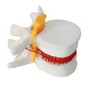 White PVC medical model of lumbar spine showing intervertebral disc herniation