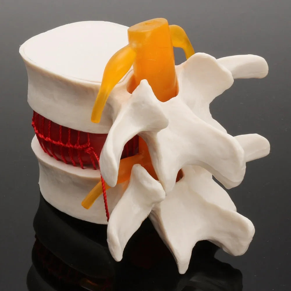White PVC medical model of lumbar spine showing intervertebral disc herniation