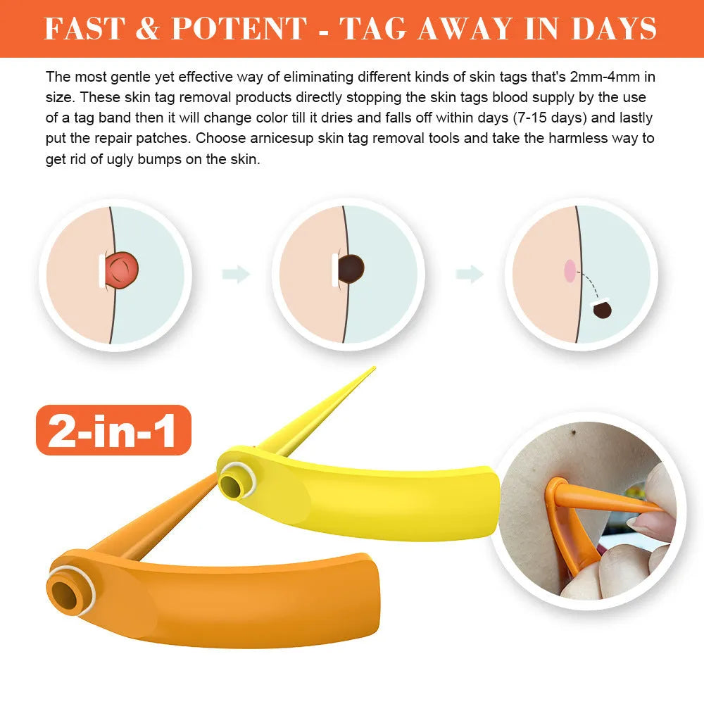Orange yellow wart removal tool kit with two devices, rubber rings, alcohol swabs and accessories