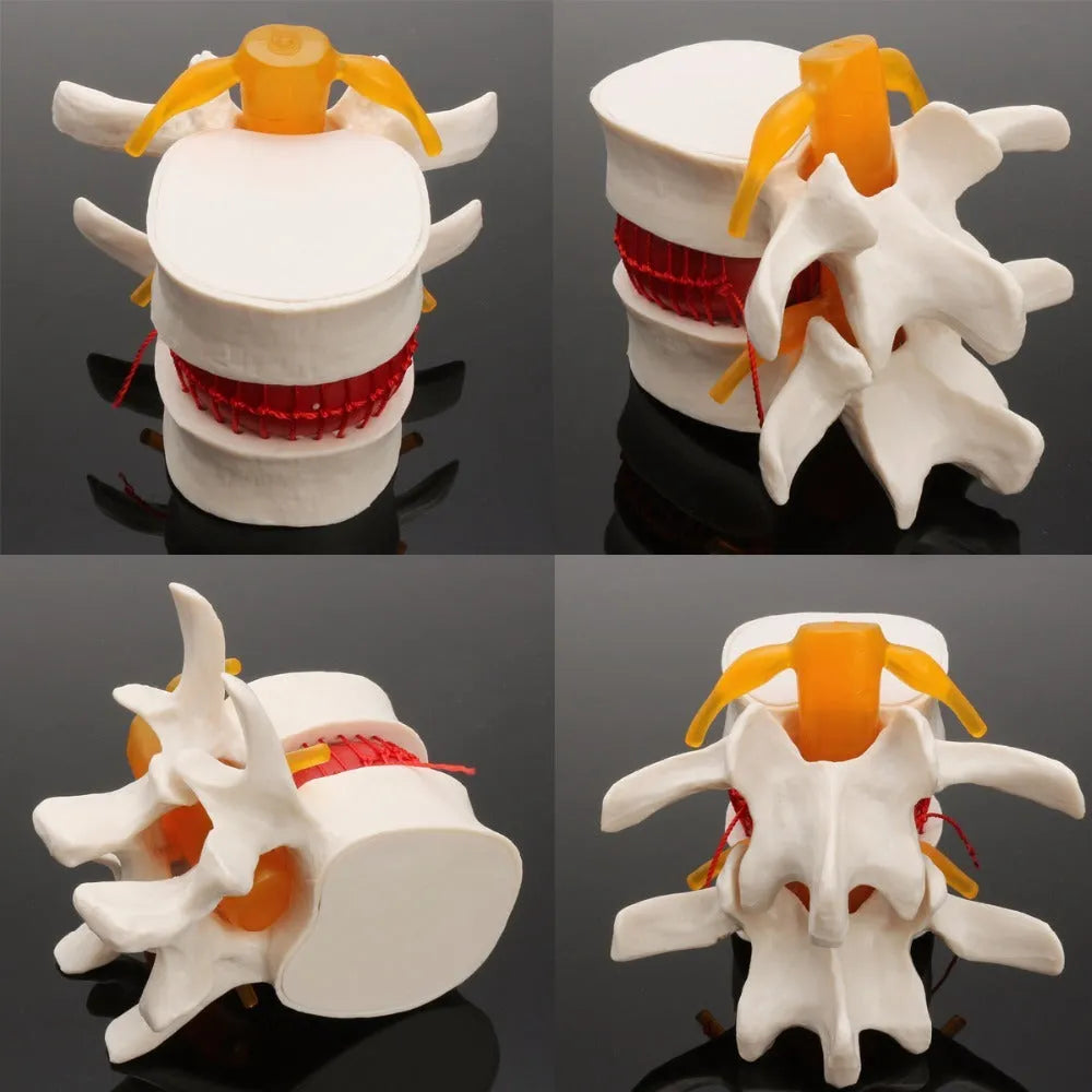 White PVC medical model of lumbar spine showing intervertebral disc herniation