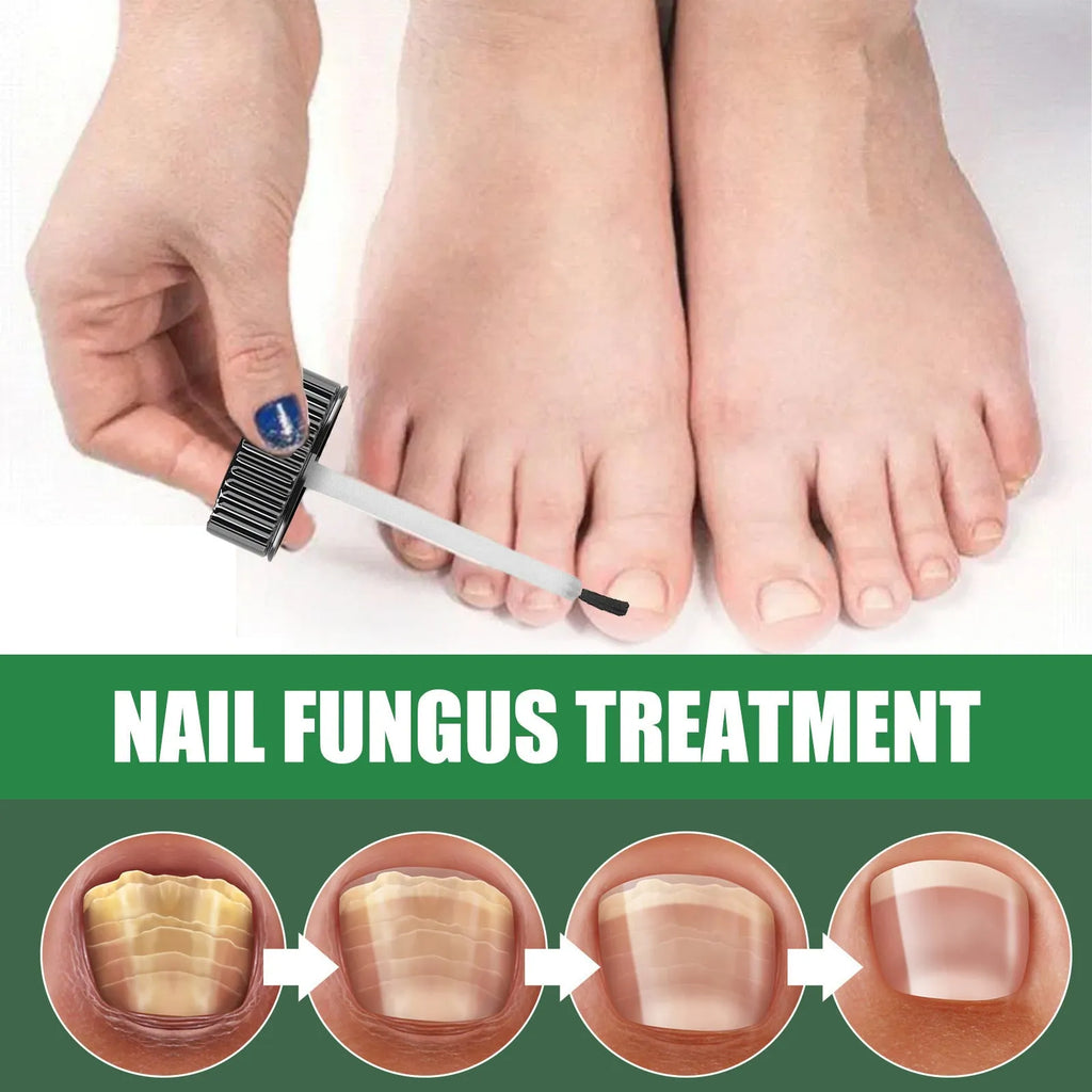 30ml tea tree oil nail care bottle with finger-thick consistency for foot and hand nail nutrition