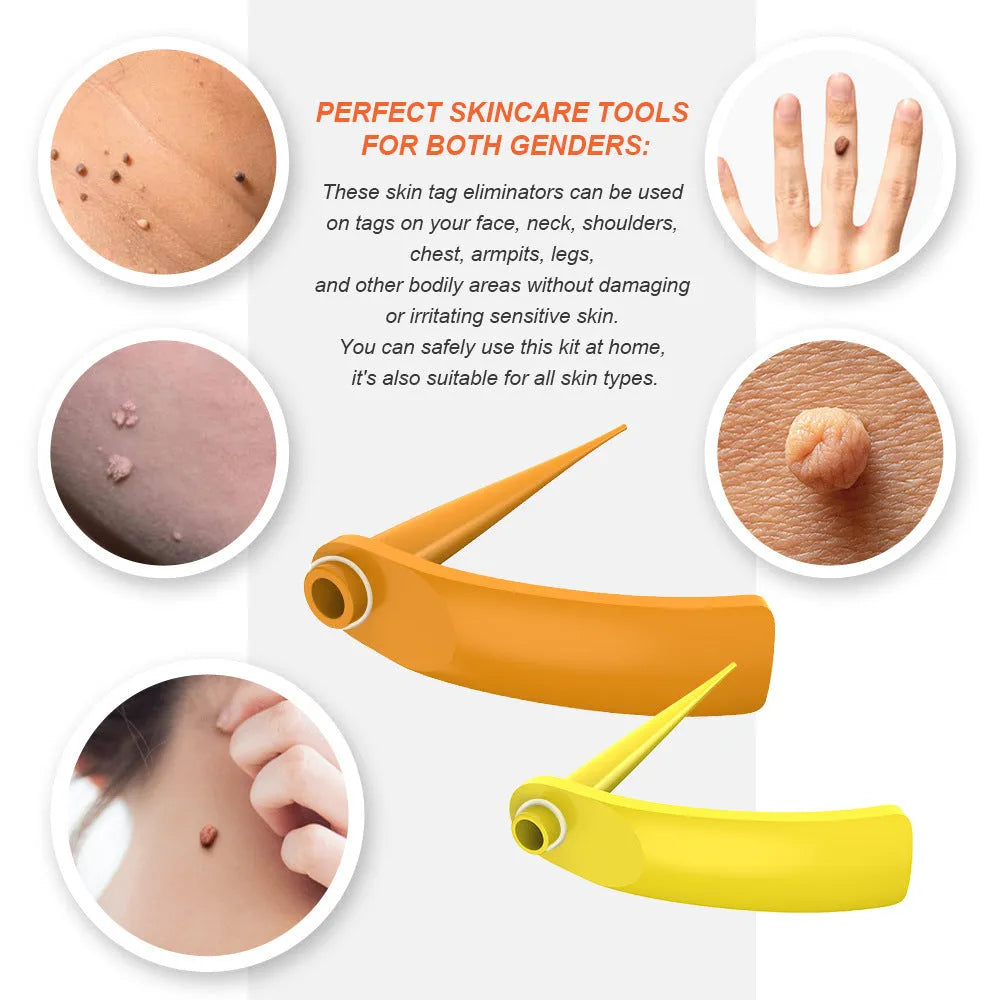 Orange yellow wart removal tool kit with two devices, rubber rings, alcohol swabs and accessories